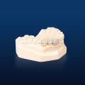 Customized Metal on Porcelain Denture